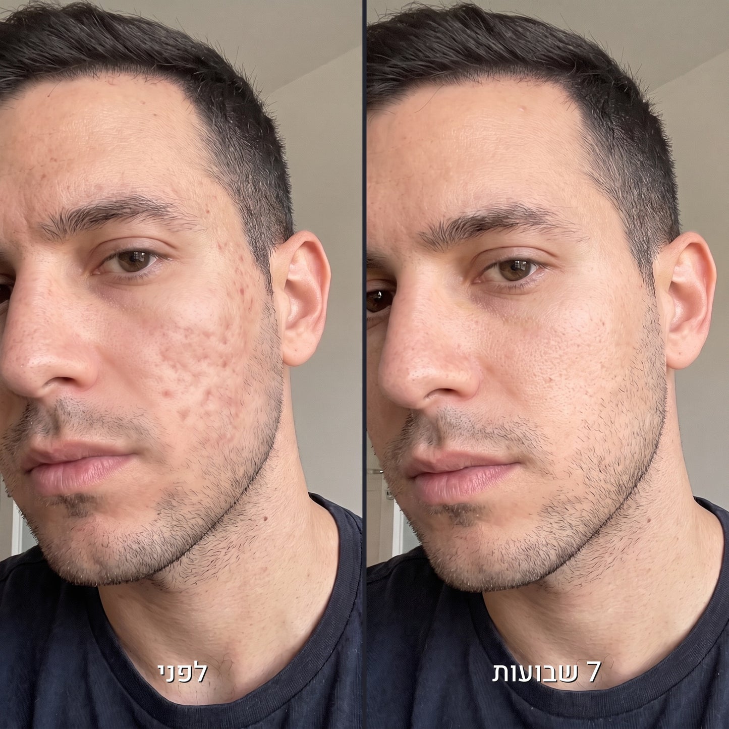 לפני ואחרי צלקות אקנה אצל גבר